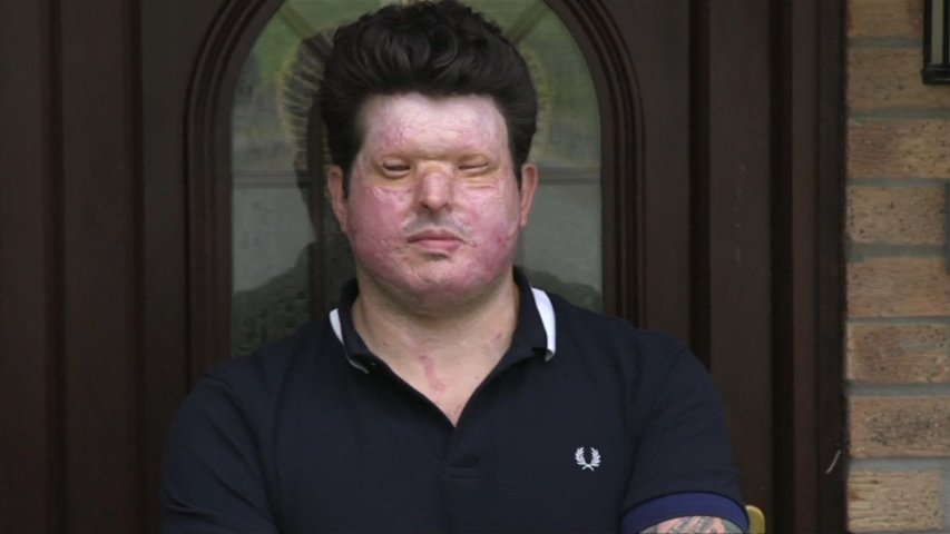 Acid attack victim calls for tougher sentences