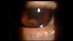Worm digs holes in teens eye for weeks