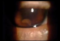 Worm digs holes in teens eye for weeks