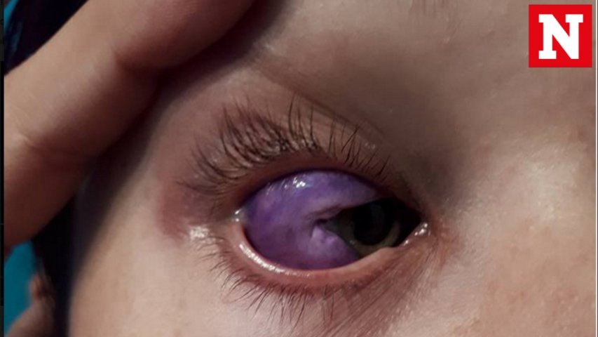 Bizarre eyeball tattoo leaves Canadian model partially blind