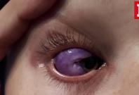 Bizarre eyeball tattoo leaves Canadian model partially blind Bizarre eyeball tattoo leaves Canadian model partially blind