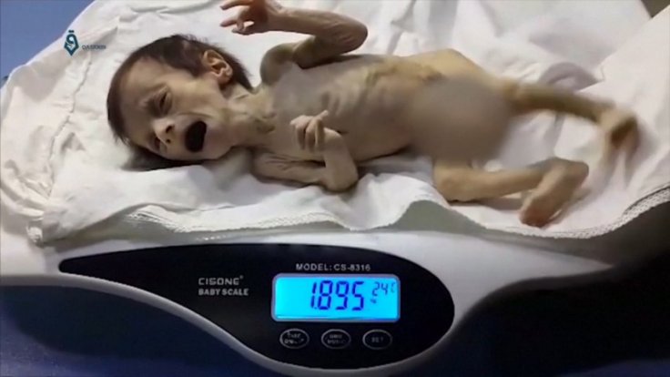 Heartbreaking footage shows extent of child malnutrition in conflict-ridden Syria