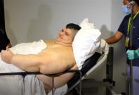 Worlds fattest man has surgery to halve his weight