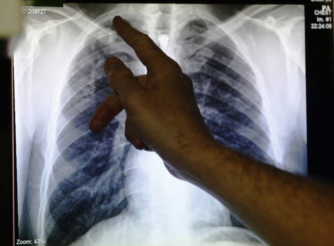 New method to combat Tuberculosis