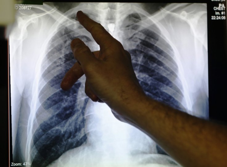 New method to combat Tuberculosis