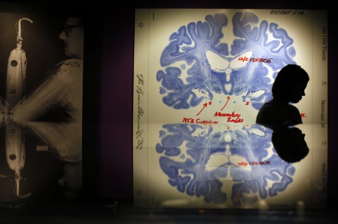 A woman walks past a display of a brain slice of patient A woman walks past a display of a brain slice of patient