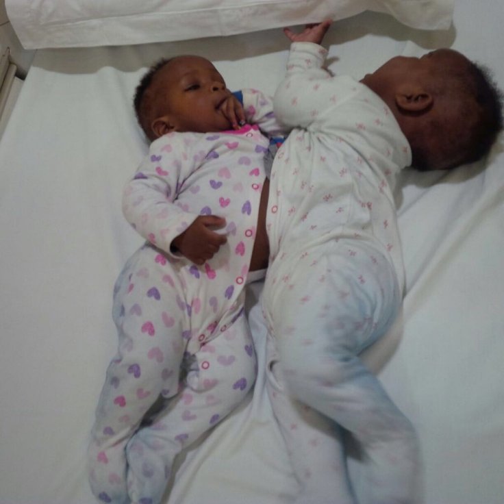 Conjoined girl twins Conjoined girl twins