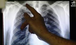obstructive pulmonary diseases