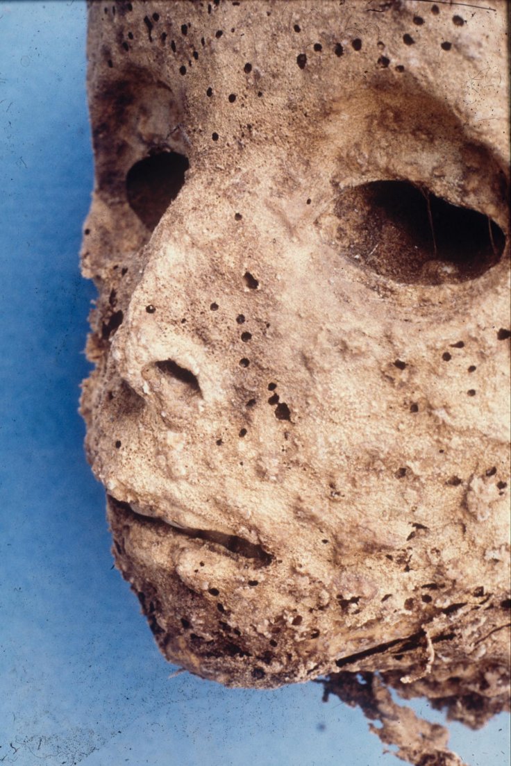 The mummified remains of a small child buried in the Basilica of Saint Domenico Maggiore in Naples, Italy. Previous analysis of the 16th century remains had suggested the child was infected with smallpox, in what had been believed to be the earliest dated