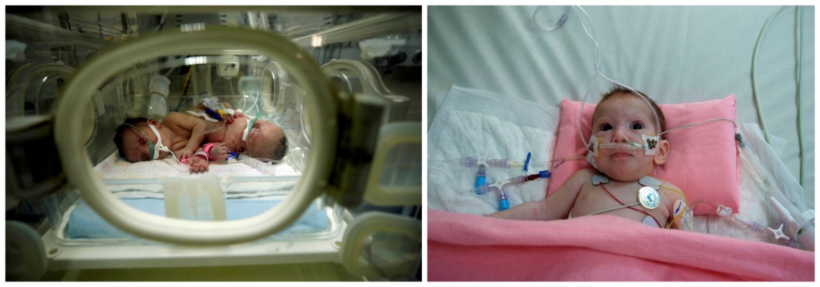  conjoined twins Haneen and Farah in an incubator at a hospital in Gaza