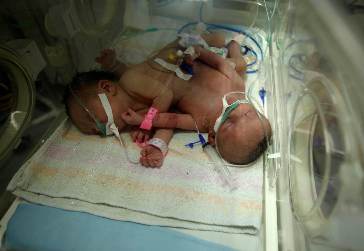 Conjoined twins Haneen and Farah are seen in an incubator at a hospital in Gaza City