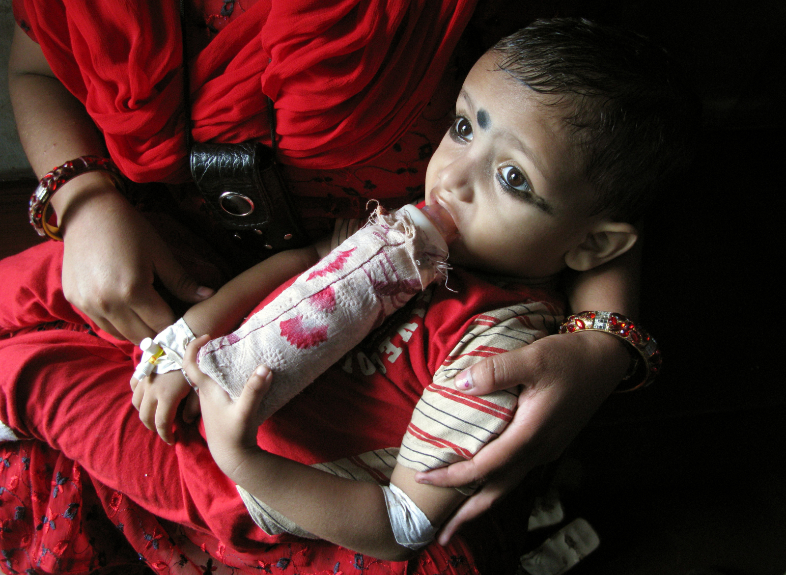 A baby suffering from Thalassemia 