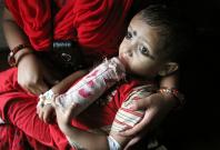 A baby suffering from Thalassemia 