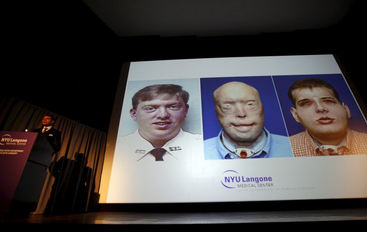 Conference on Face transplant