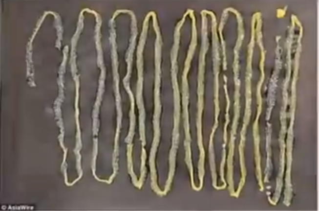 Singapore 9 Foot Long Tapeworm Found Inside Mans Rectum