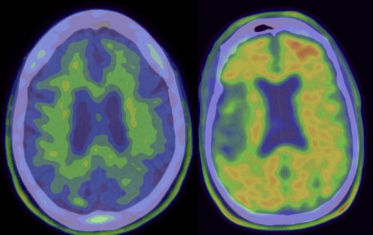 alzheimers alzheimers