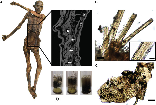 The Iceman’s Gastrointestinal Tract