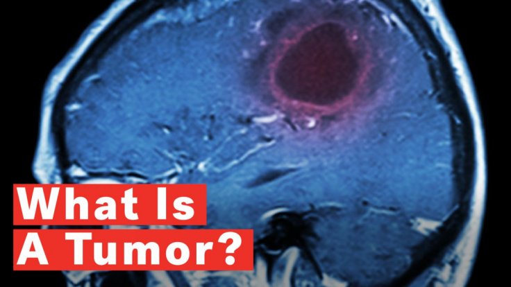 what-is-a-tumor what-is-a-tumor