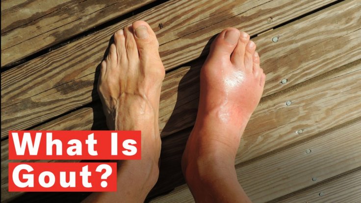 what-is-gout what-is-gout
