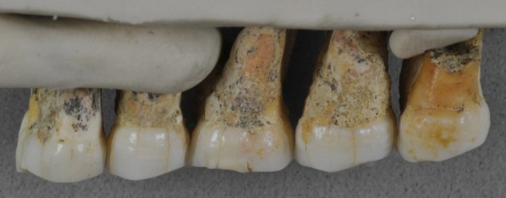 The teeth bones recovered from Callao Caves of the Philippines island of Luzon display characteristics of early humans as well as modern humans. From left: Two premolars and three molars.Courtesy: Callao Cave Archaeology Project The teeth bones recovered from Callao Caves of the Philippines island of Luzon display characteristics of early humans as well as modern humans. From left: Two premolars and three molars.Courtesy: Callao Cave Archaeology Project