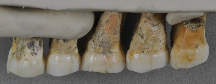 The teeth bones recovered from Callao Caves of the Philippines island of Luzon display characteristics of early humans as well as modern humans. From left: Two premolars and three molars.Courtesy: Callao Cave Archaeology Project