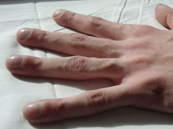 Cystic fibrosis Cystic fibrosis