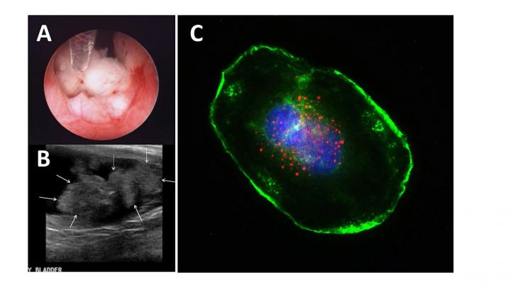 bladder cancer