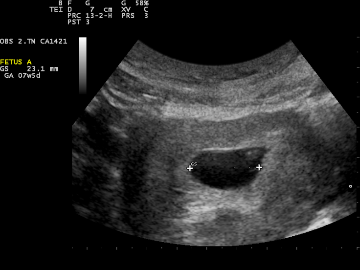 Ultrasound Scan