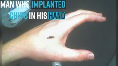 man-who-implanted-chips-in-his-hand