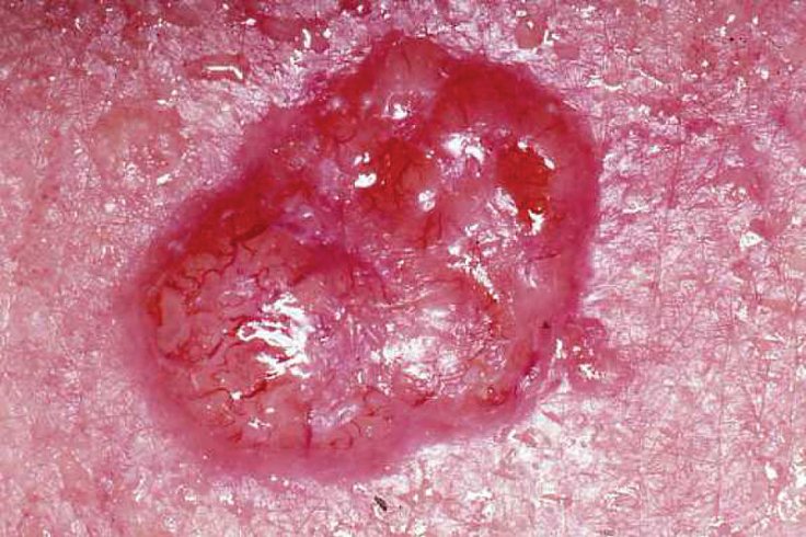 Basal cell carcinoma Basal cell carcinoma