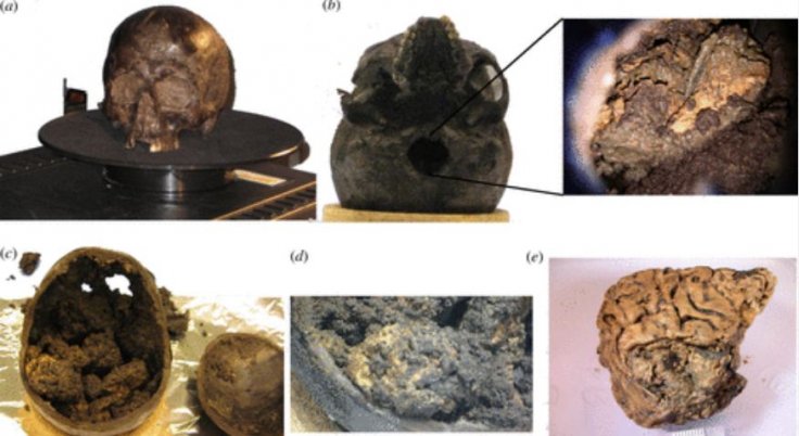 The Heslington brain. (a) All orifices of the dark skull were tightly covered with mud; (b) shows the skull base with the foramen magnum. Illumination of the inner part of the skull as seen through the foramen magnum is shown in the inlay; (c) after openi The Heslington brain. (a) All orifices of the dark skull were tightly covered with mud; (b) shows the skull base with the foramen magnum. Illumination of the inner part of the skull as seen through the foramen magnum is shown in the inlay; (c) after openi