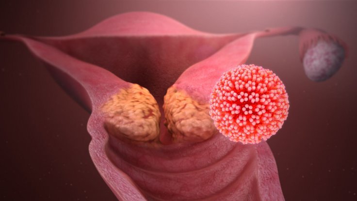 One tiny prick can keep cervical cancer at bay, say scientists