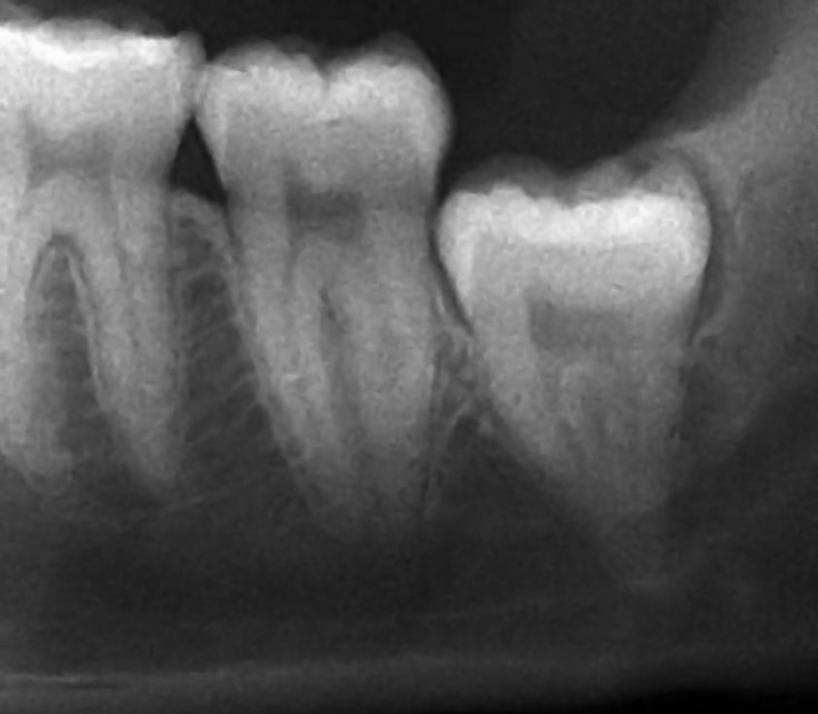 An impacted wisdom tooth (Representational Picture)