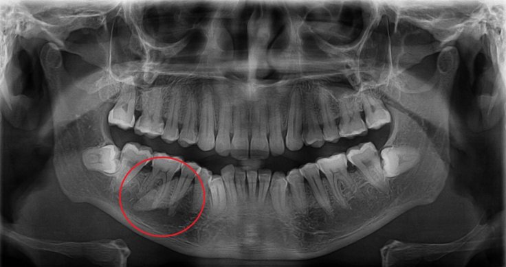 Figure 1 Orthopantomogram showing a linear radiopacity overlapping the lower right second premolar and first molar