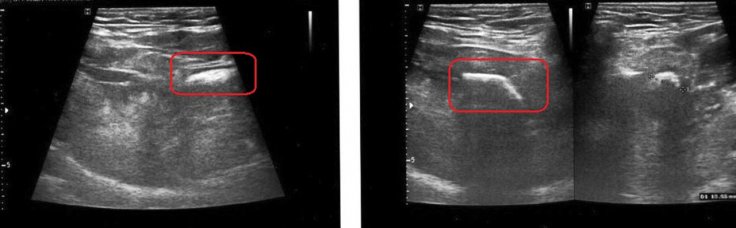 Figure 2Ultrasonography of the submandibular region showing sialolith.