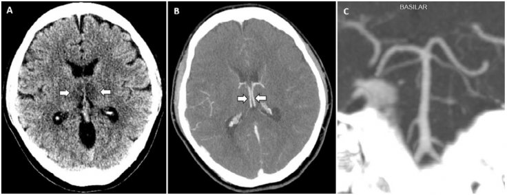 CT scans of Coronavirus patients