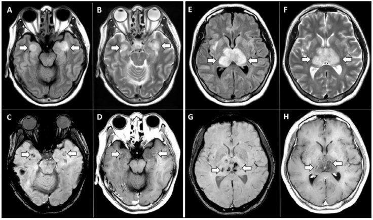 Scans of coronavirus patient