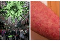 coronavirus skin rashes