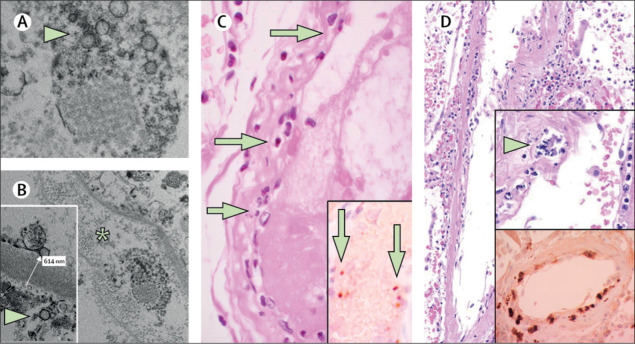 Viral infection in lining of blood vessels