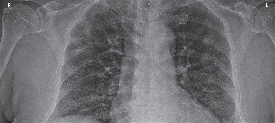 First case of 2019 novel coronavirus in Canada