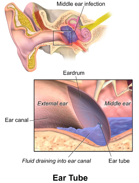 Ear infection 