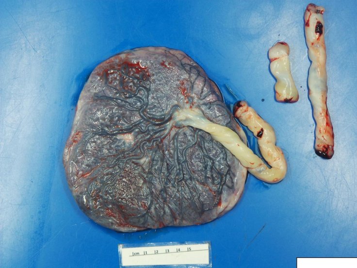  placenta from a patient with coronavirus