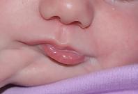 Baby born with second mouth