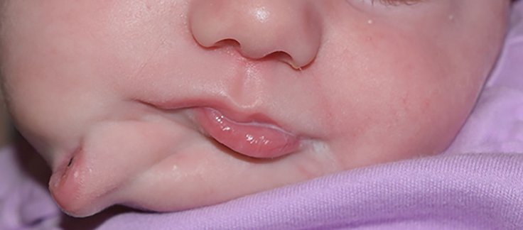 Baby born with second mouth