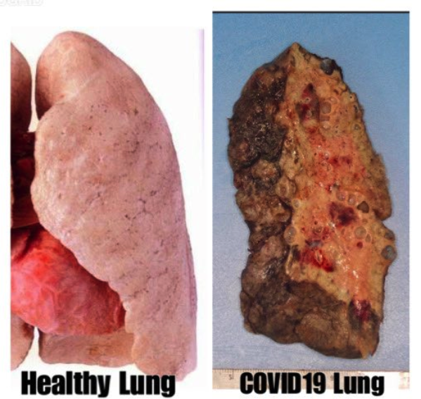 Lung damage caused by COVID-19