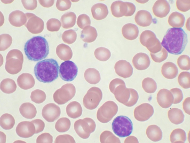 Blood Cancer