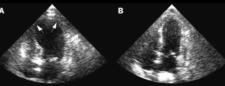 Echocardiogram in BHS