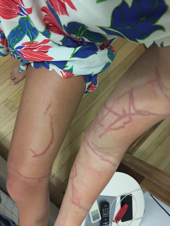 Scars left by box jellyfish sting