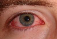 Pink eye or Conjunctivitis