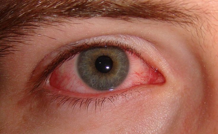 Pink eye or Conjunctivitis